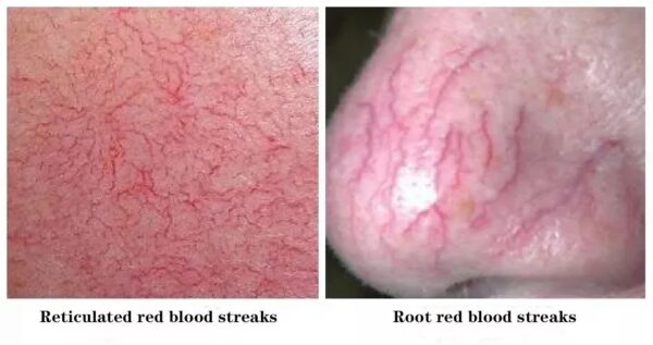 980nm diode laser spider veins removal vascular removal spider removal machine - Image 2